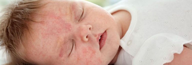 Le traitement de l’eczéma du bébé en ligne